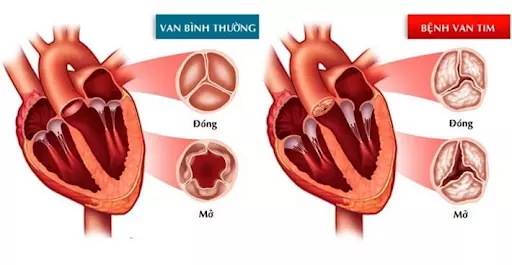 Hở van tim có thể ảnh hưởng đến chức năng co bóp của tim và gây nên các triệu chứng đau ngực.webp